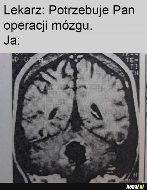 Operacja mózgu